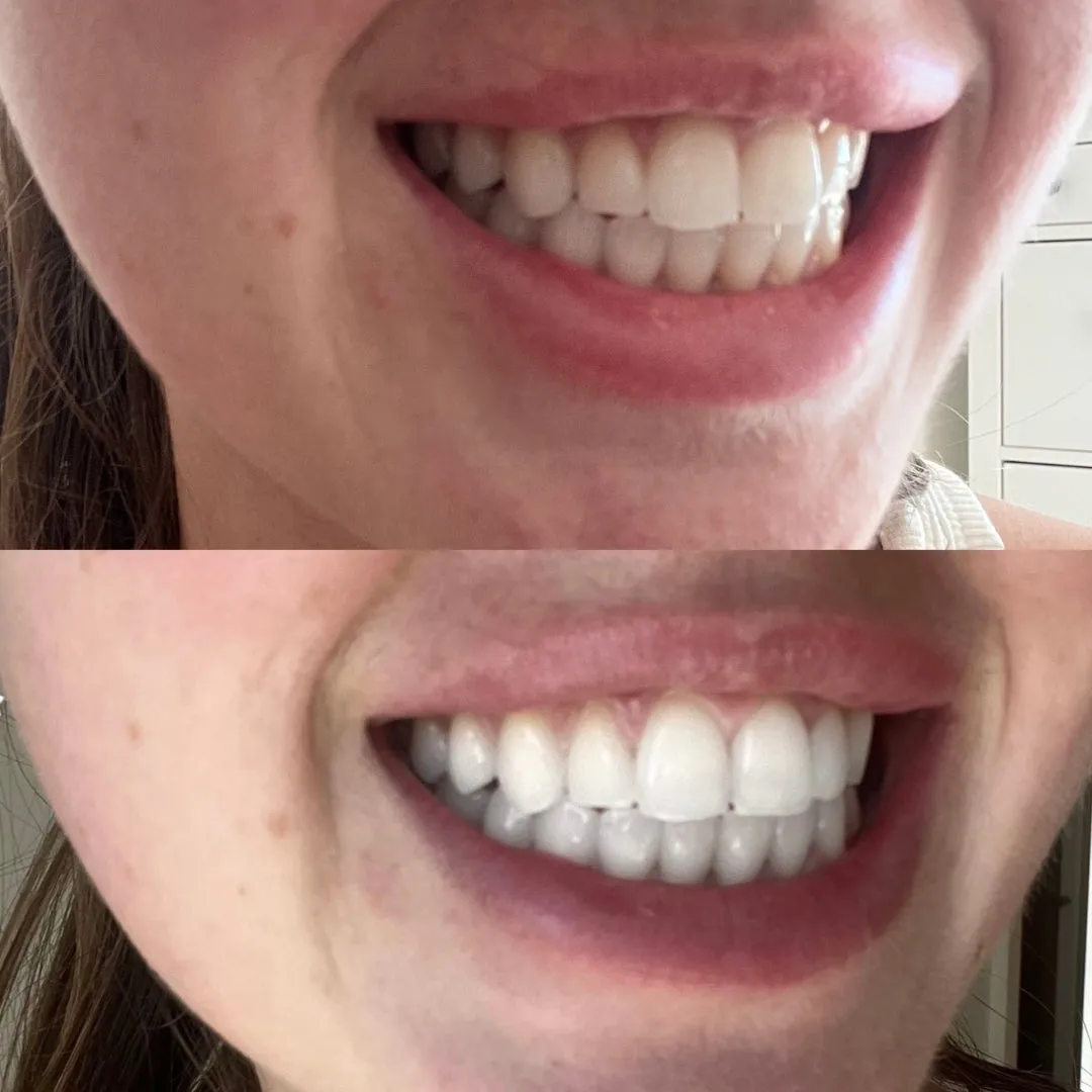 2 Boxes Teeth Whitening Strips