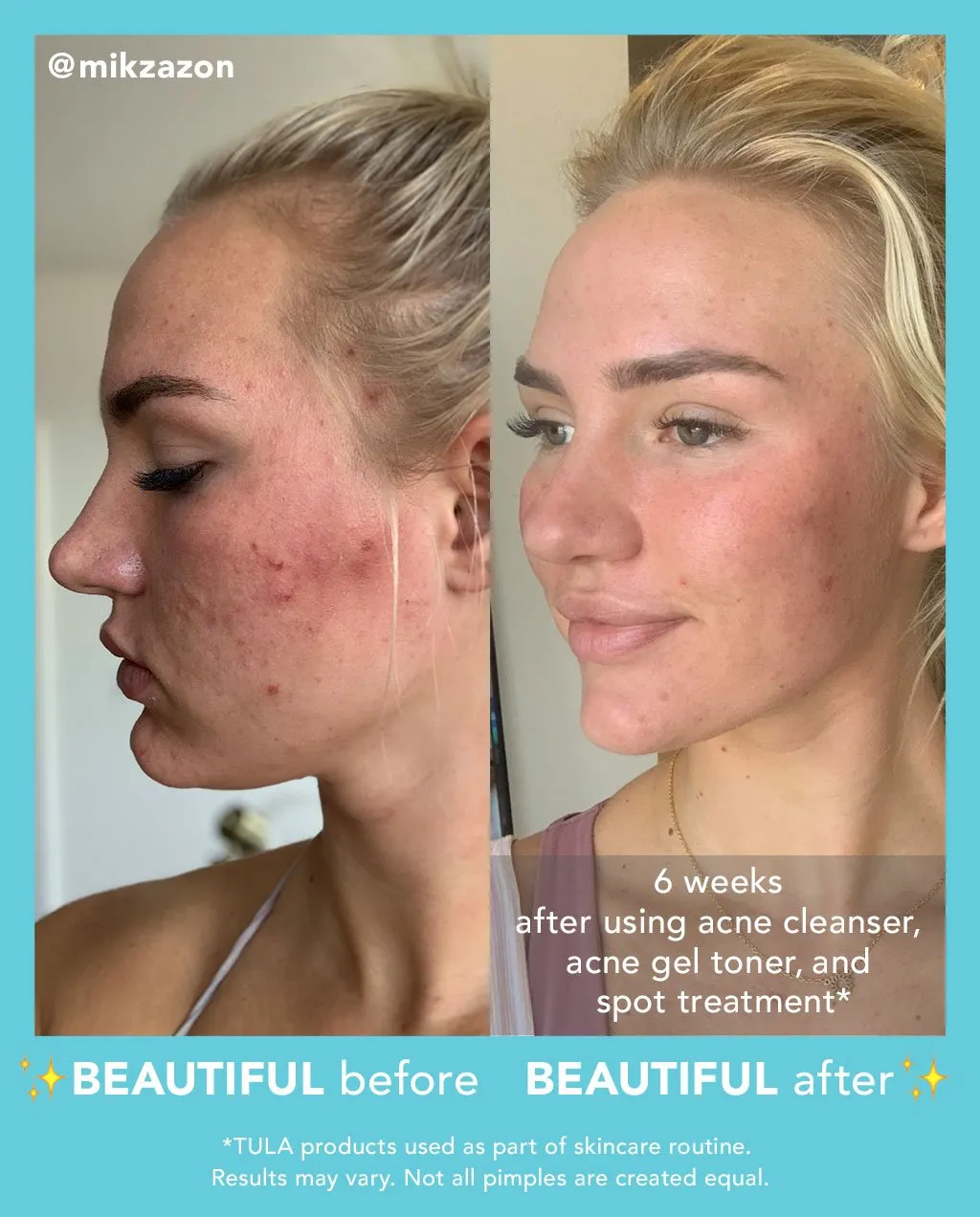 Acne Spot Treatment