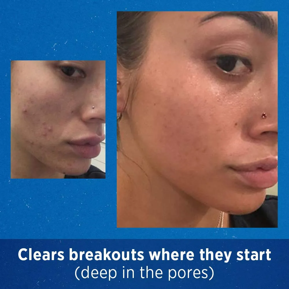 Acne Treatment Differin Gel for Face with Adapalene, Clears and Prevents Acne, Up to 30 Day Supply, 15g Pump