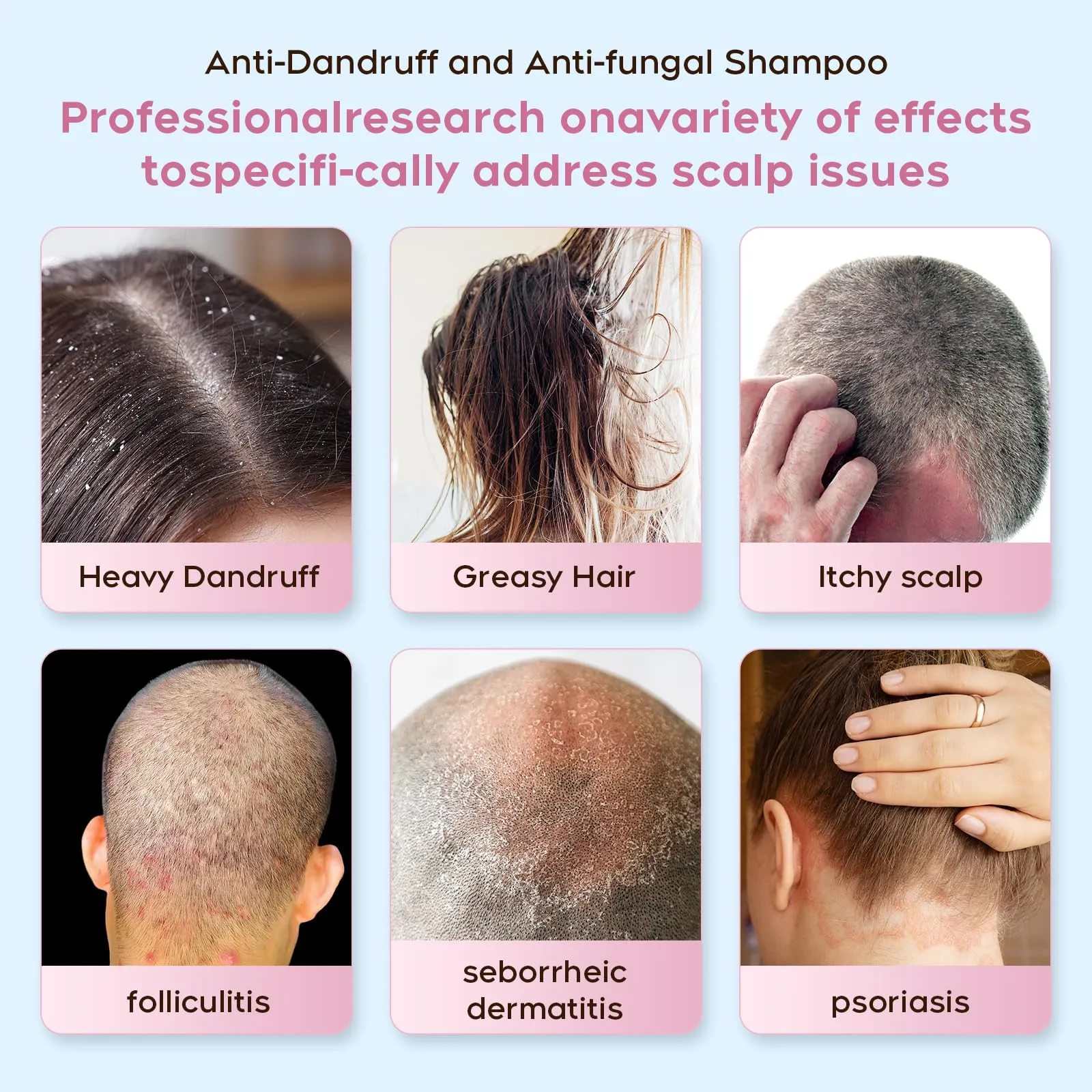 Anti-Dandruff and Anti-fungal Shampoo - Treats Folliculitis, Seborrheic Dermatitis, Psoriasis - Relieves Itchy, Dry Itchy Scalp Treatment, For Normal to Oily Scalp Prone to Folliculitis, 8.4 fl. oz