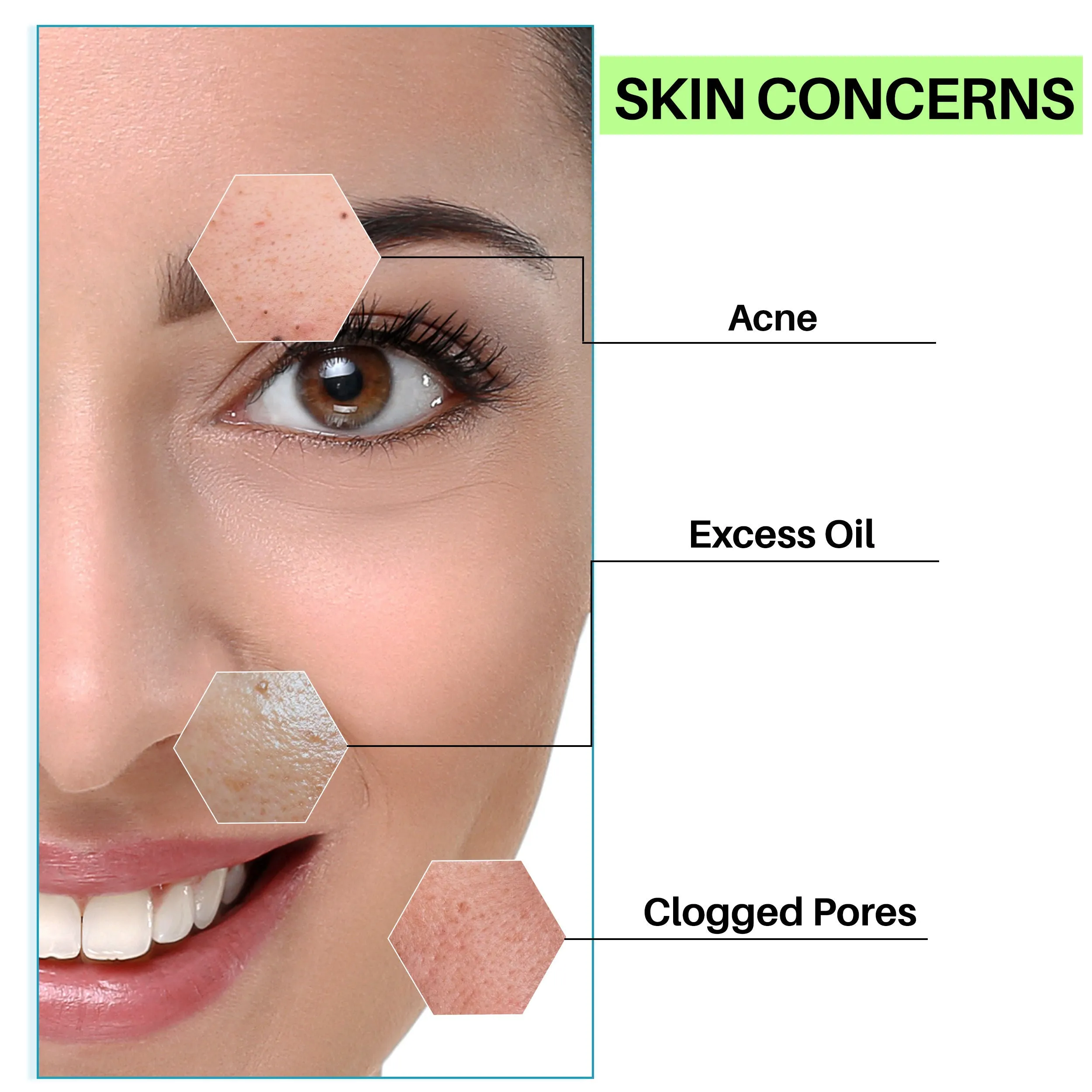DermDoc Salicylic Acid Face Wash for Acne (200 ml)|For Oily & Acne Prone Skin|Reduces Acne & Blackheads, Regularizes Sebum Production, Evens Skin Texture|Paraben Free, Silicone Free, Sulfate Free, Cruelty Free