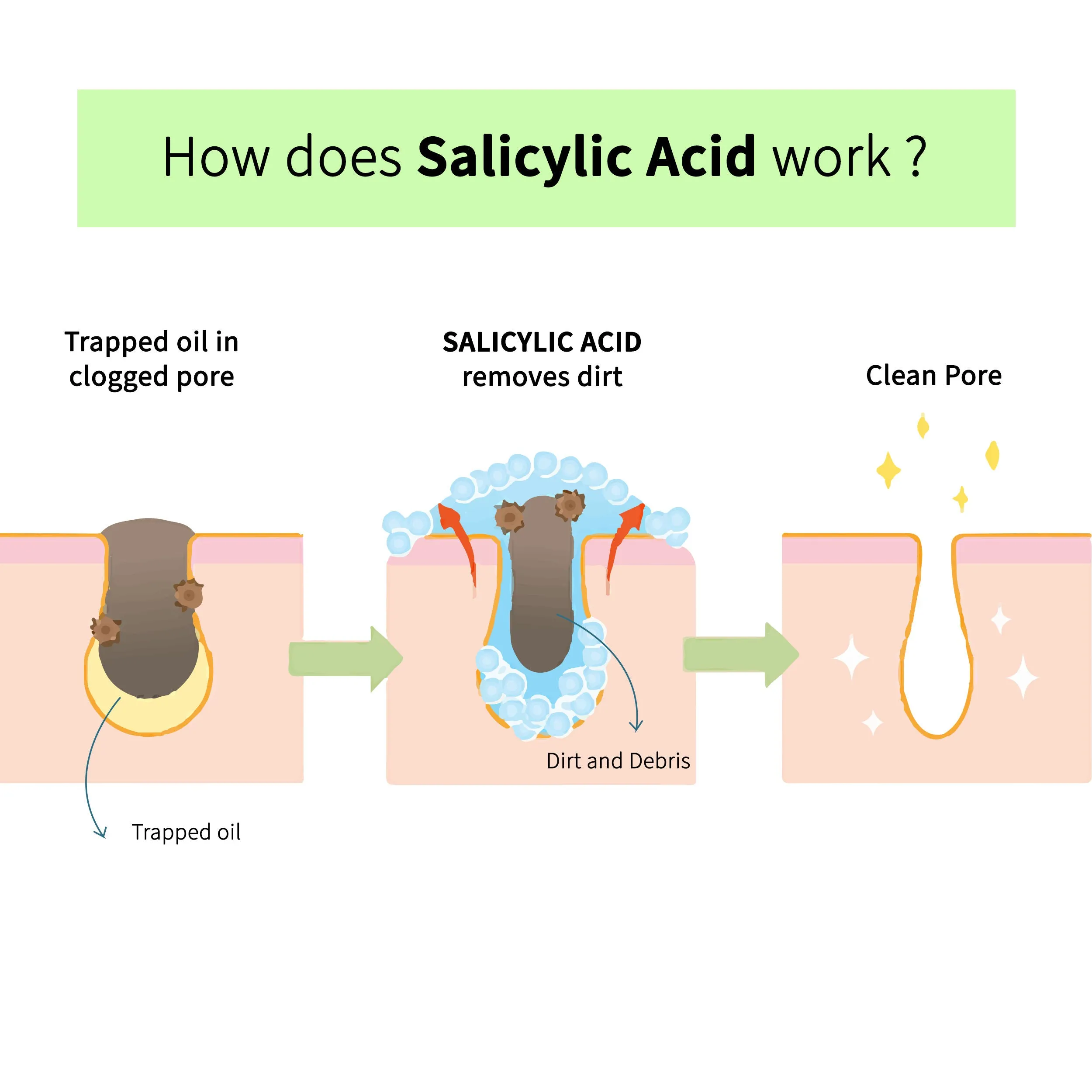 DermDoc Salicylic Acid Face Wash for Acne (200 ml)|For Oily & Acne Prone Skin|Reduces Acne & Blackheads, Regularizes Sebum Production, Evens Skin Texture|Paraben Free, Silicone Free, Sulfate Free, Cruelty Free