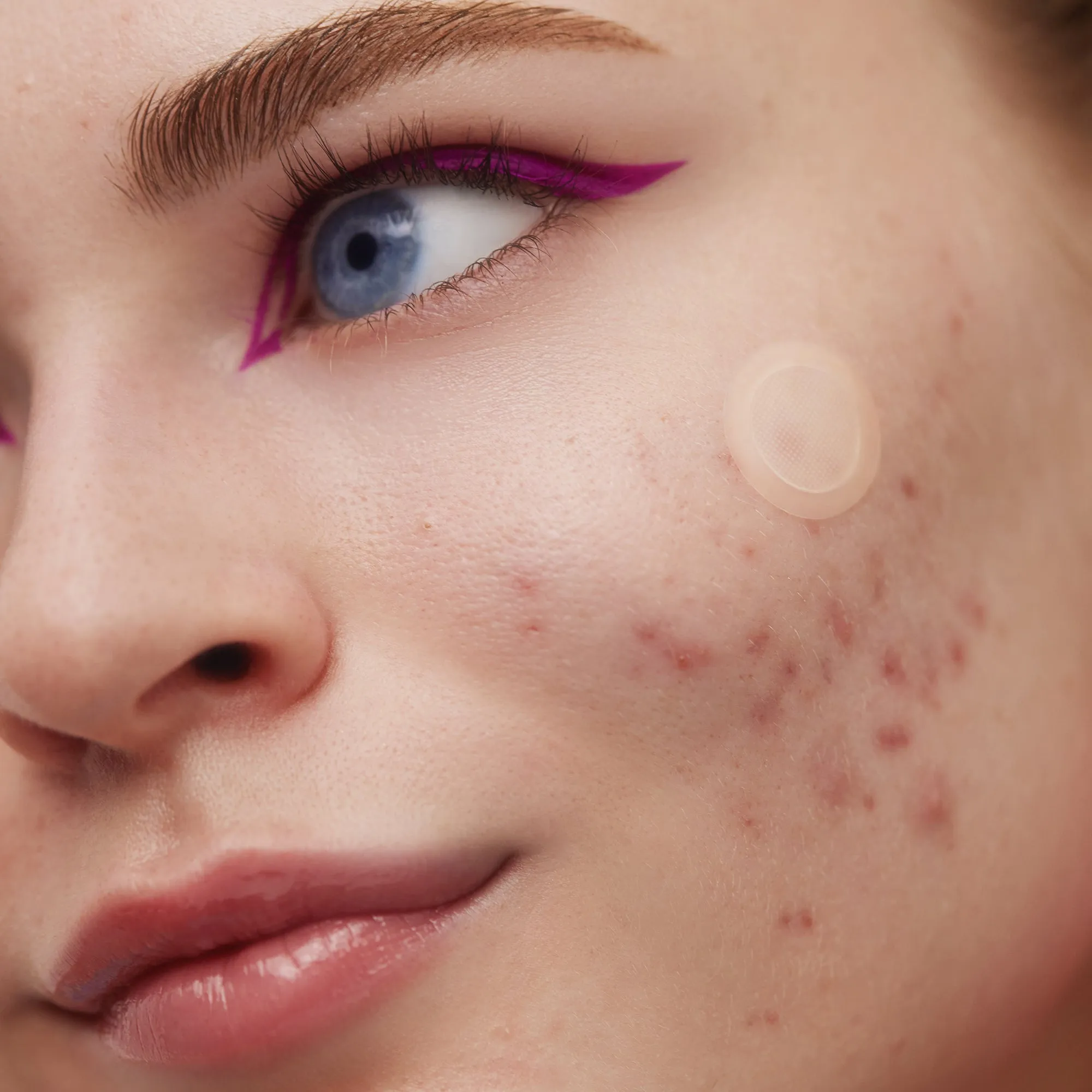 Early Stage Acne Dots