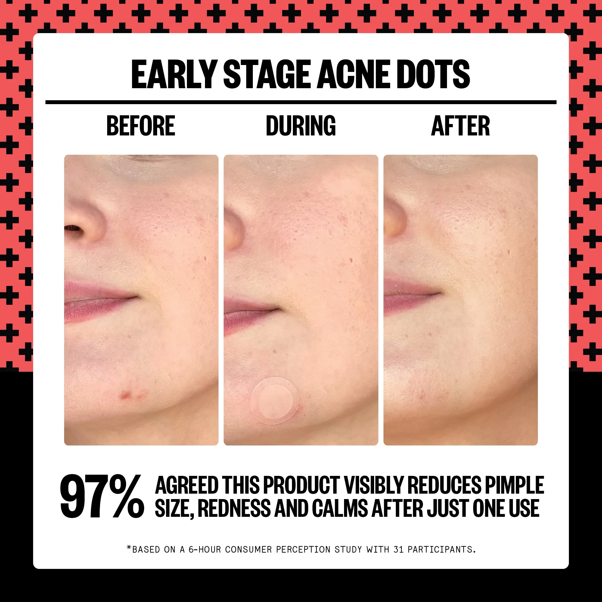 Early Stage Acne Dots