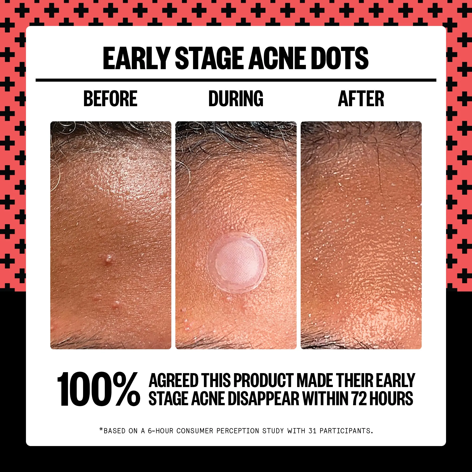 Early Stage Acne Dots