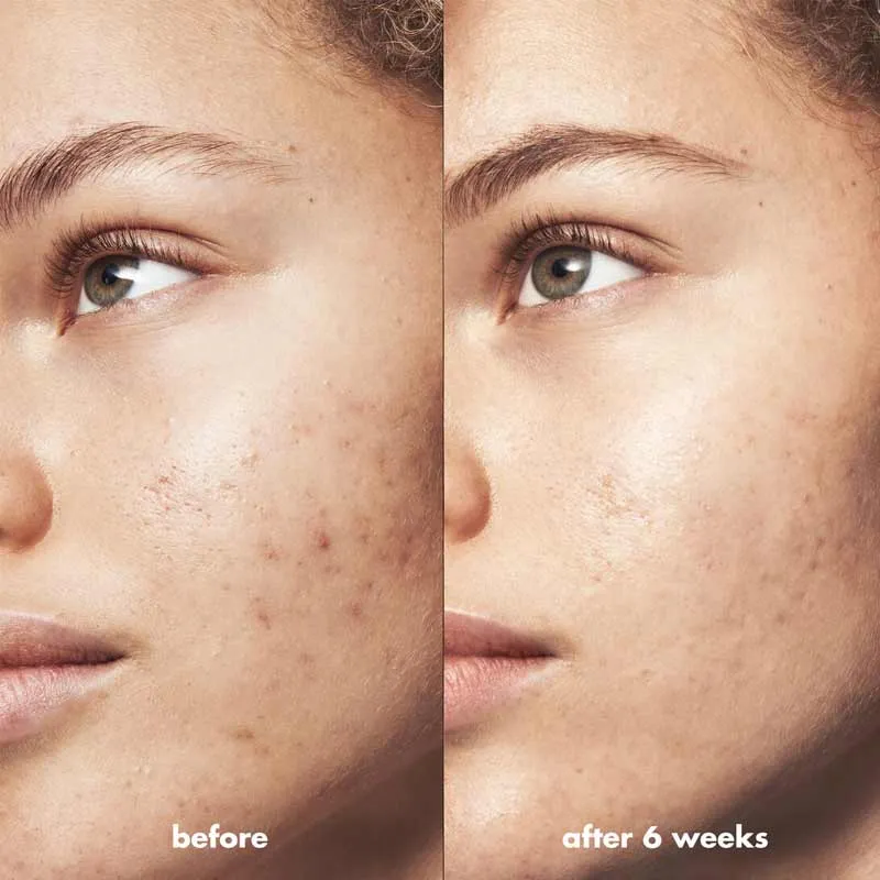e.l.f. Blemish Breakthrough Blemish Fighting Spot Gel Discontinued